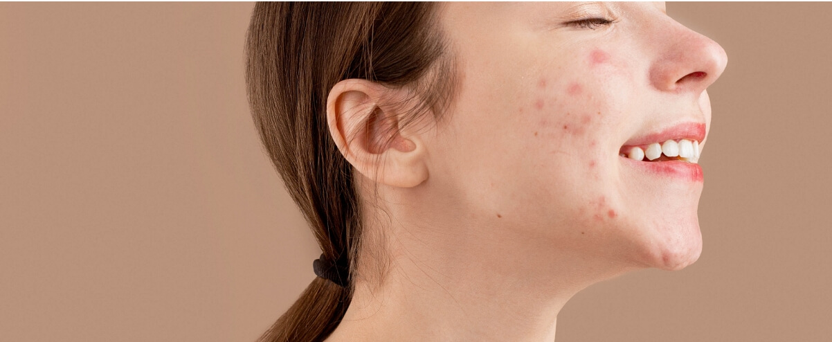 How Food Intolerance Can Trigger Acne<br />
